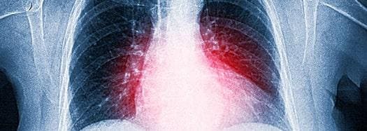 x ray of chest and heart