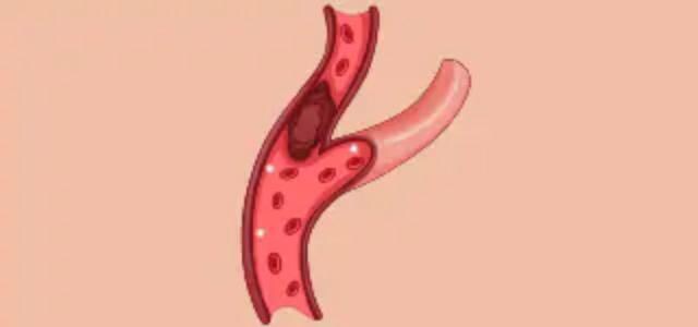illustration of a clogged artery